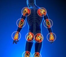 Arthritis