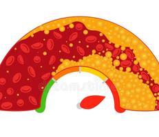 High Cholesterol